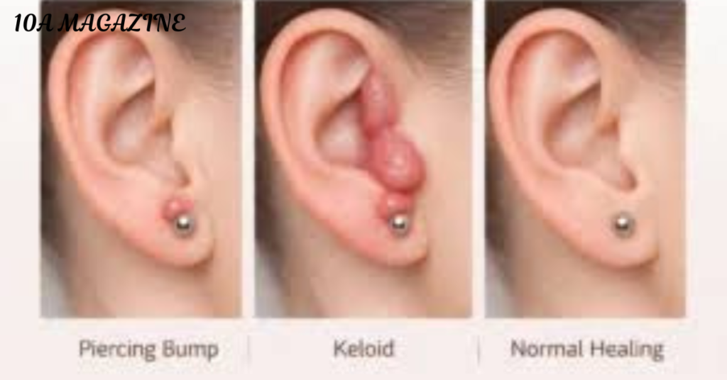 What Exactly Is a Piercing Bump?