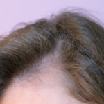Does Tirzepatide Cause Hair Loss