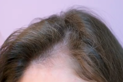 Does Tirzepatide Cause Hair Loss