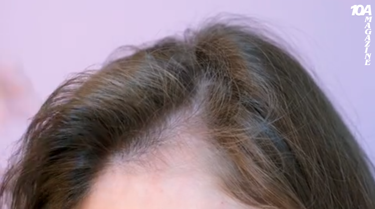 Does Tirzepatide Cause Hair Loss