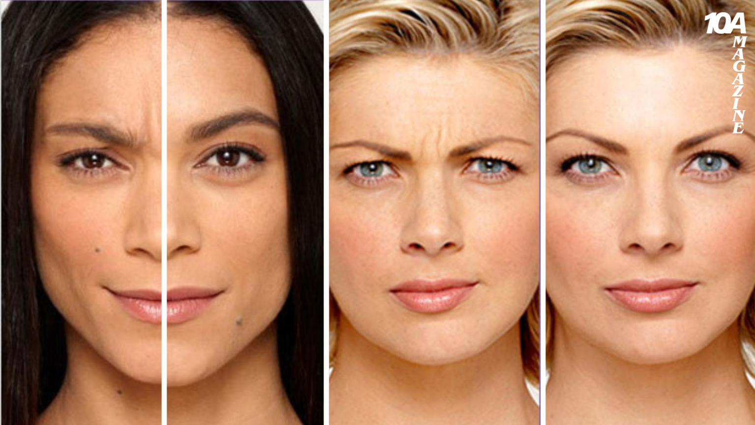 how long does botox last