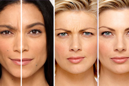 how long does botox last