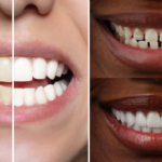 How Much Do Veneers Cost