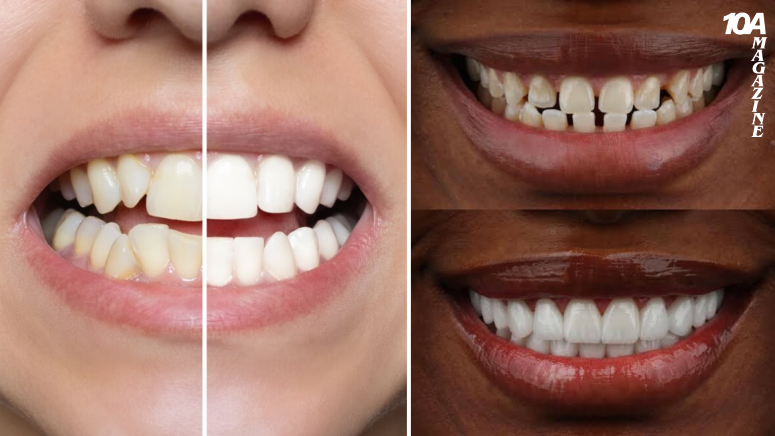 How Much Do Veneers Cost