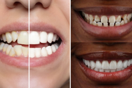 How Much Do Veneers Cost