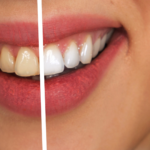 How to Get Whiter Teeth