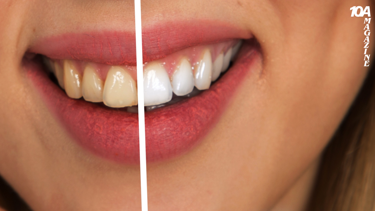 How to Get Whiter Teeth