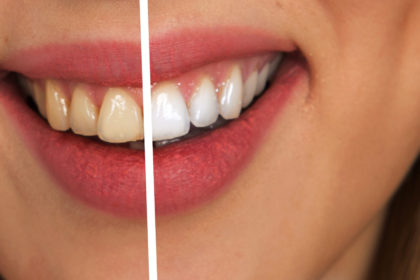 How to Get Whiter Teeth