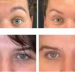 how long does botox last