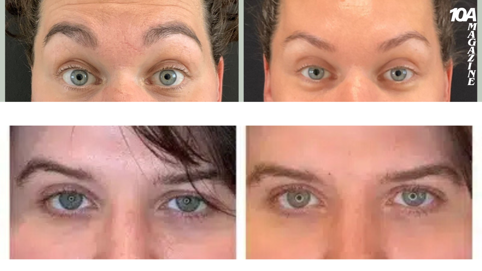 how long does botox last
