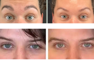 how long does botox last