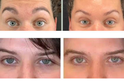 how long does botox last